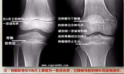 在这段时间里人体骨骺线基本闭合,同时骨骼逐渐钙化,人体也逐渐停止